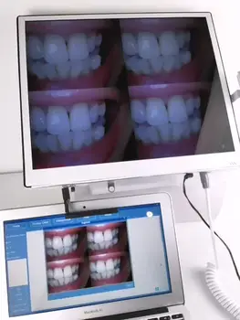 5 Milioane de Pixeli dinte intra orală camera scanne intraorale 3d intra orală fort portabil dinte unitate